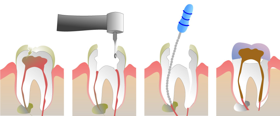 A graphic showing the stages of a root canal.