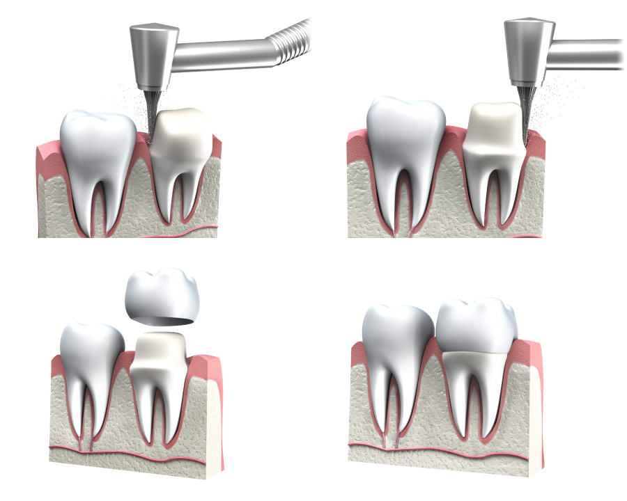 A graphic showing the preparation for a dental crown.