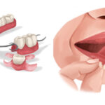 Illustration of partial dentures next to a woman taking out her full dentures