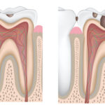 Illustration of the stages of tooth decay