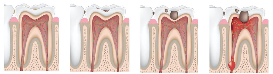 Illustration of the stages of tooth decay