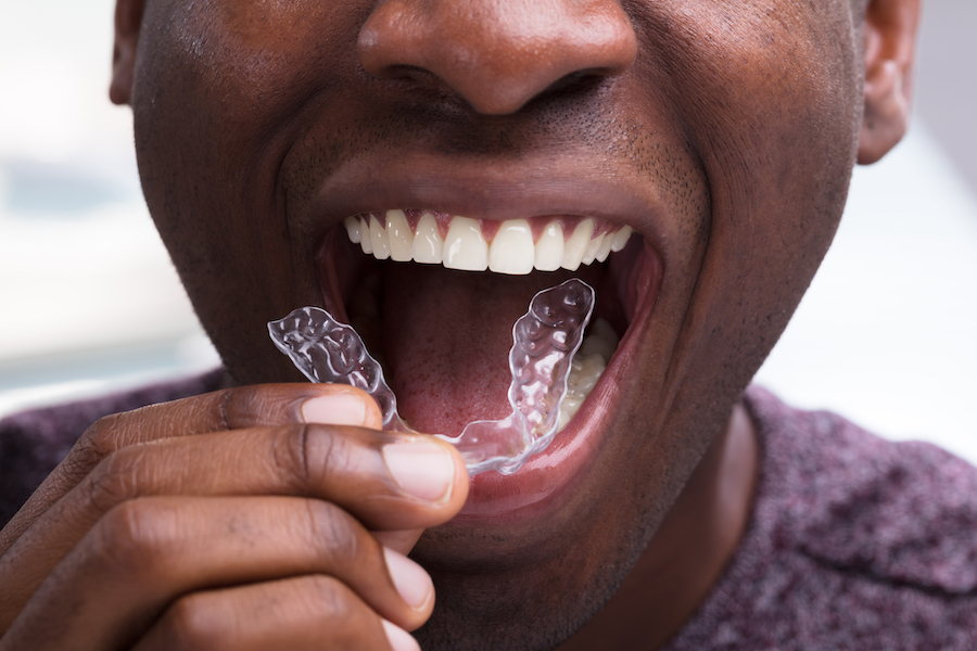 Photograph of Black man inserting Invisalign clear aligners, can boost self-esteem