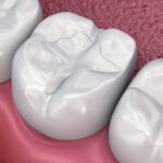tooth-colored filling, composite filling, get rid of old amalgam, dentist in jonesboro