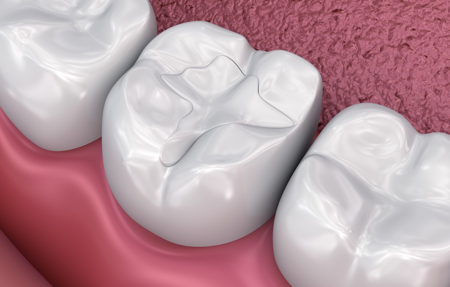 tooth-colored filling, composite filling, get rid of old amalgam, dentist in jonesboro
