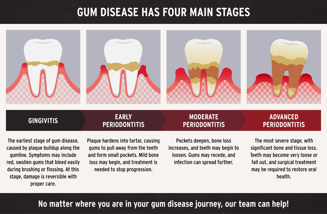 infographic showing the four stages of gum disease