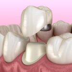 dental crowns jonesboro ar at wagner langston