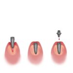 dental implant timeline, dental implant process