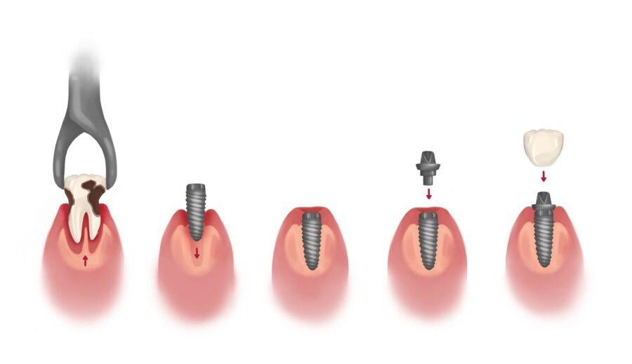 dental implant timeline, dental implant process